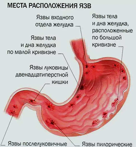 Каллезная язва желудка