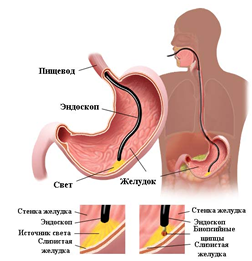 Лечение субкардиальных язв желудка thumbnail