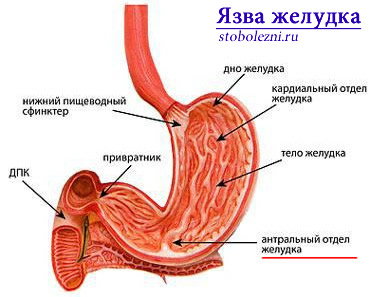 Осложнения язвы кардиального отдела желудка thumbnail