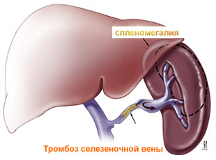 Тромбоз селезеночной вены.