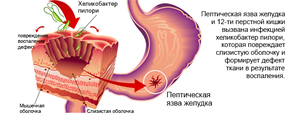 Пептическая язва желудка