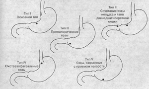 Локализация пяти распостраненых тип язвы желудка